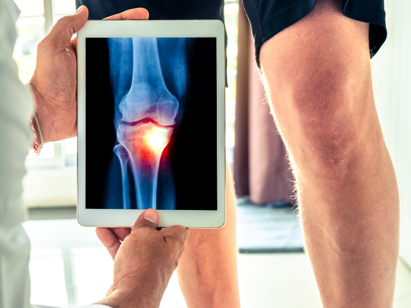 Arthrose (7) Diagnostic de l’arthrose