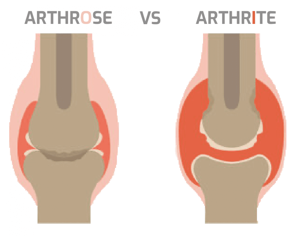 quelle différence arthrose vs arthrite