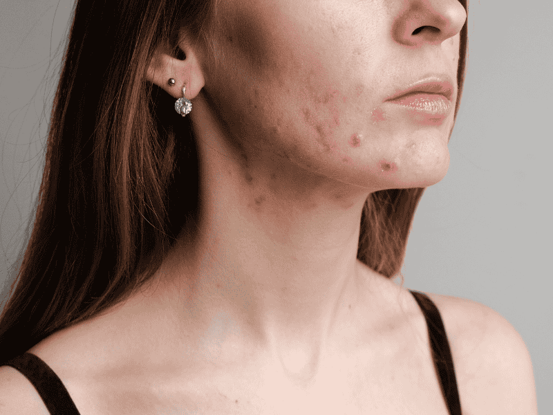 acné et candidose acné et candidose