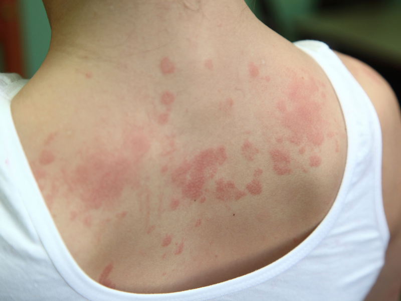 dermatite herpétiforme