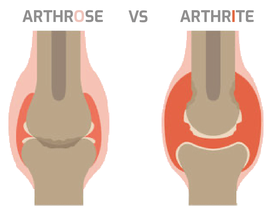 quelle différence arthrose vs arthrite
