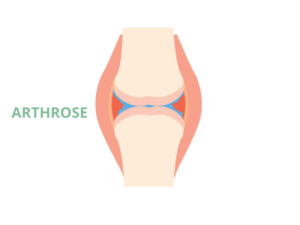 Arthrose