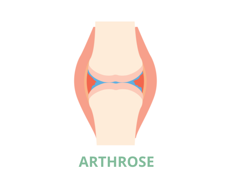 Arthrose novalturel