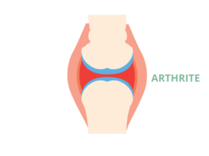 Arthrite