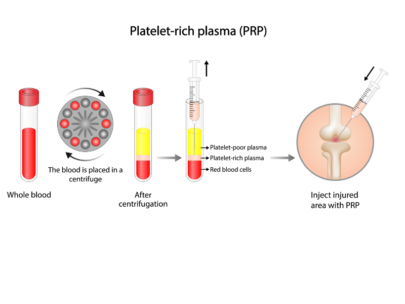 Plasma Riche en Plaquettes Plasma Riche en Plaquettes